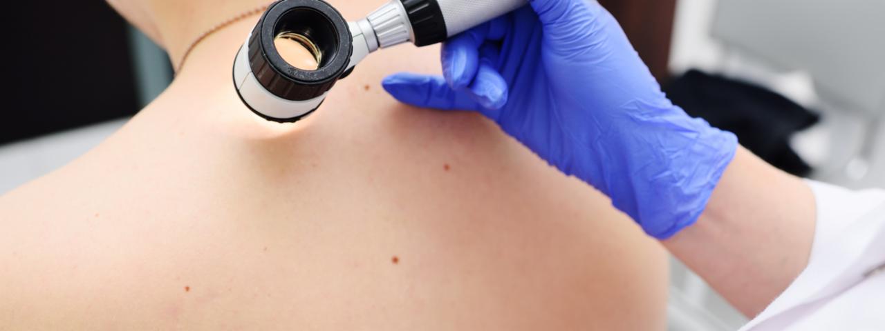 Okrugli stol – Integriranom skrbi do boljih ishoda u dijagnostici i liječenju melanoma