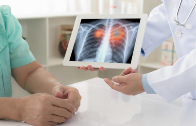 Okrugli stol - Pravovremeno otkrivanje i liječenje karcinoma pluća