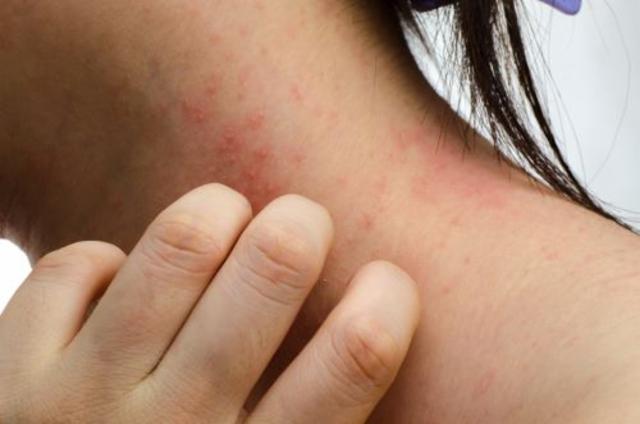 Mjesto JAK inhibitora u liječenju atopijskog dermatitisa. Odgovori na često postavljena pitanja